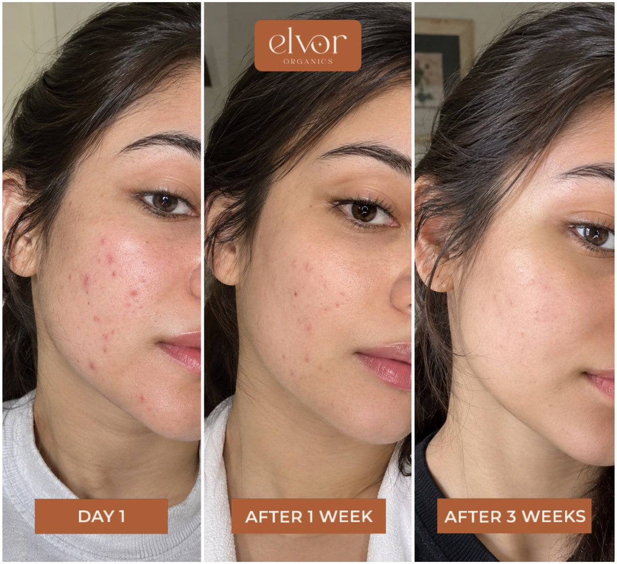 ELVOR ACNE CARE